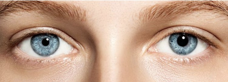 Anisocoria — pupilas de tamanhos diferentes